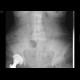 Casting renal stones, nefrolithiasis: X-ray - Plain radiograph